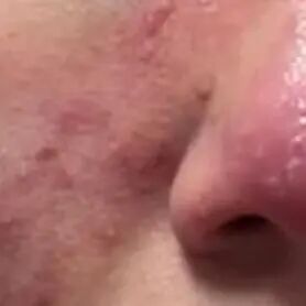 动不动就脸红?你以为的敏感肌,其实是种皮肤病