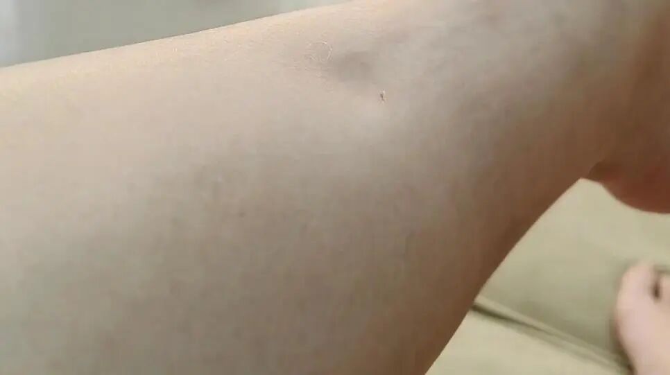 孕妈小腿突然肿至两倍粗!孕期水肿竟藏致命险疾