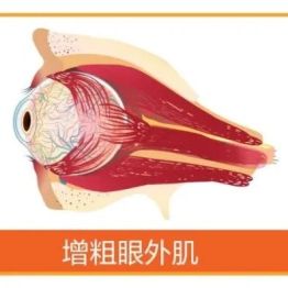 比结节更易找上门，这个眼病格外偏爱女性！