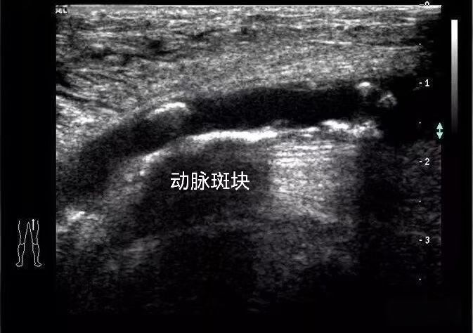 【超声科普】下肢血管超声检查:洞察腿部健康的「透视眼」