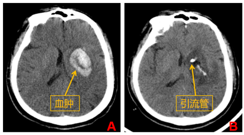 微创新高度!机器人辅助精准手术,让复杂脑病治疗更「聪明」