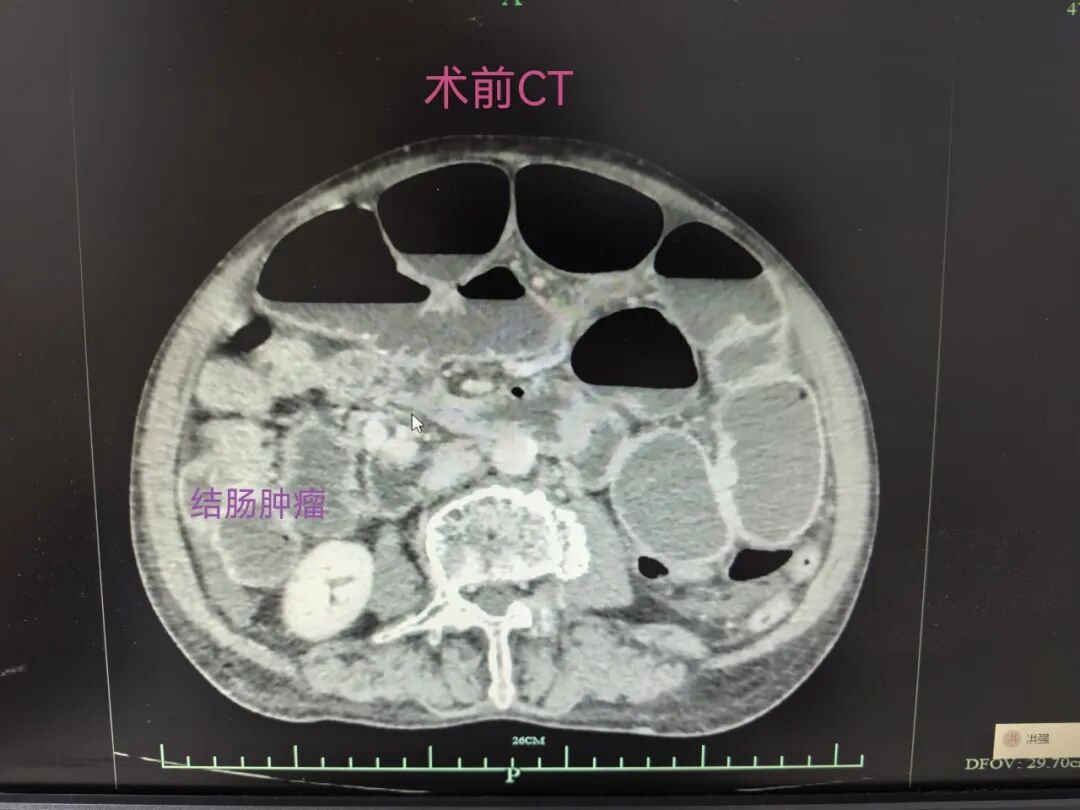 肠子「炸」!医生徒手清出一盆「SHI」,提醒很多人忽视了这件事…