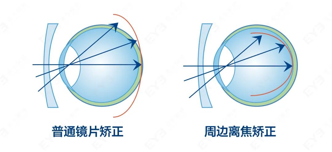眼镜度数配低一点,近视增长会更慢?