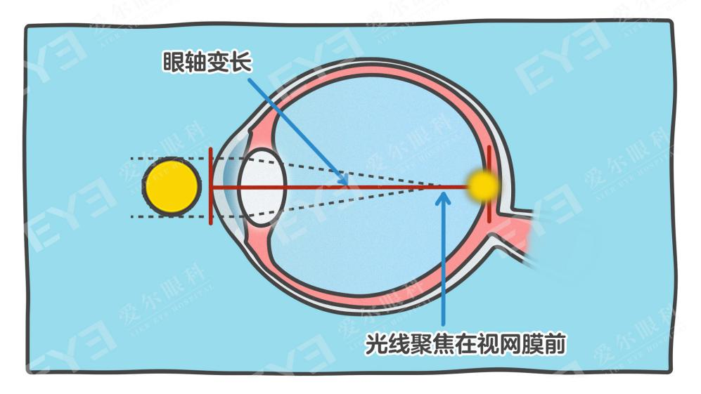 眼镜度数配低一点,近视增长会更慢?