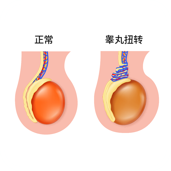 差点切除!剧烈运动后突发剧痛,这种「蛋疼」千万别硬扛