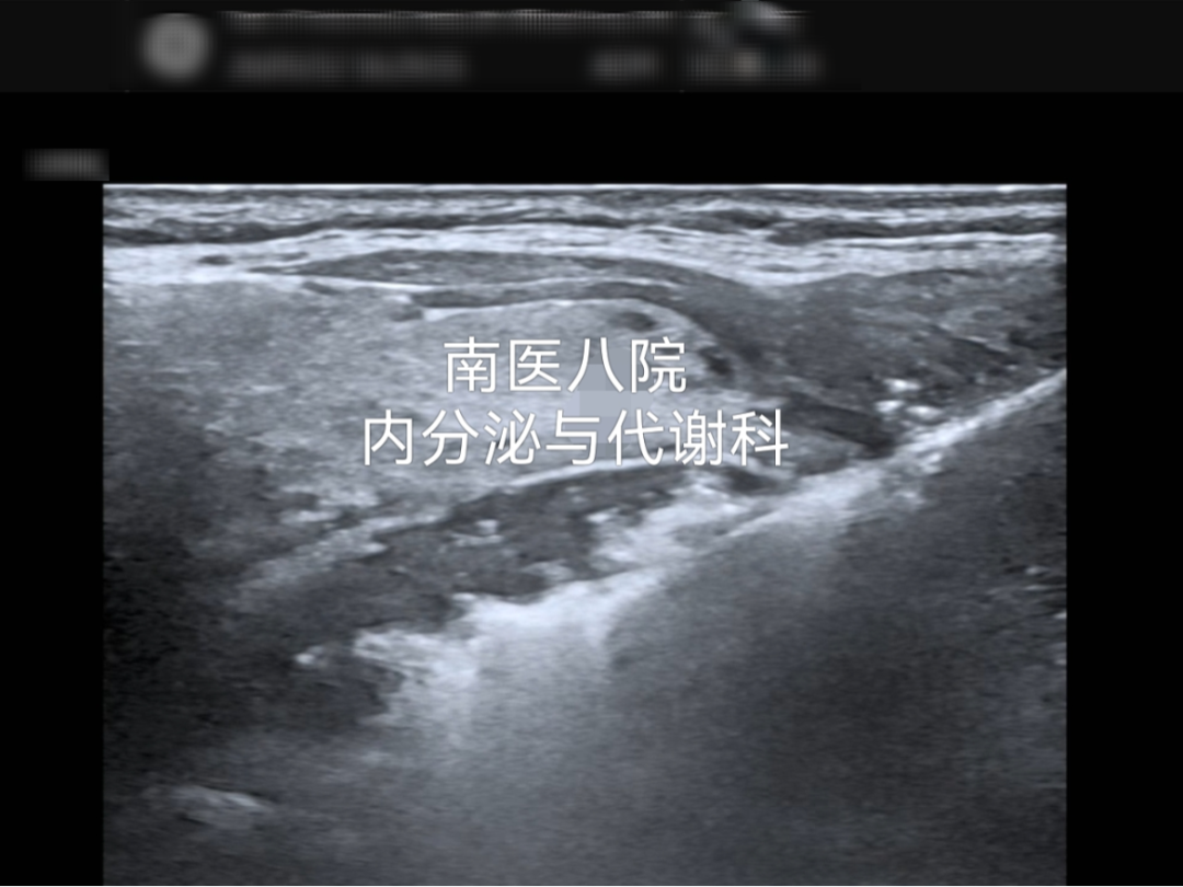 「针」实力!我院内分泌与代谢科甲状旁腺瘤热消融技术为患者解忧