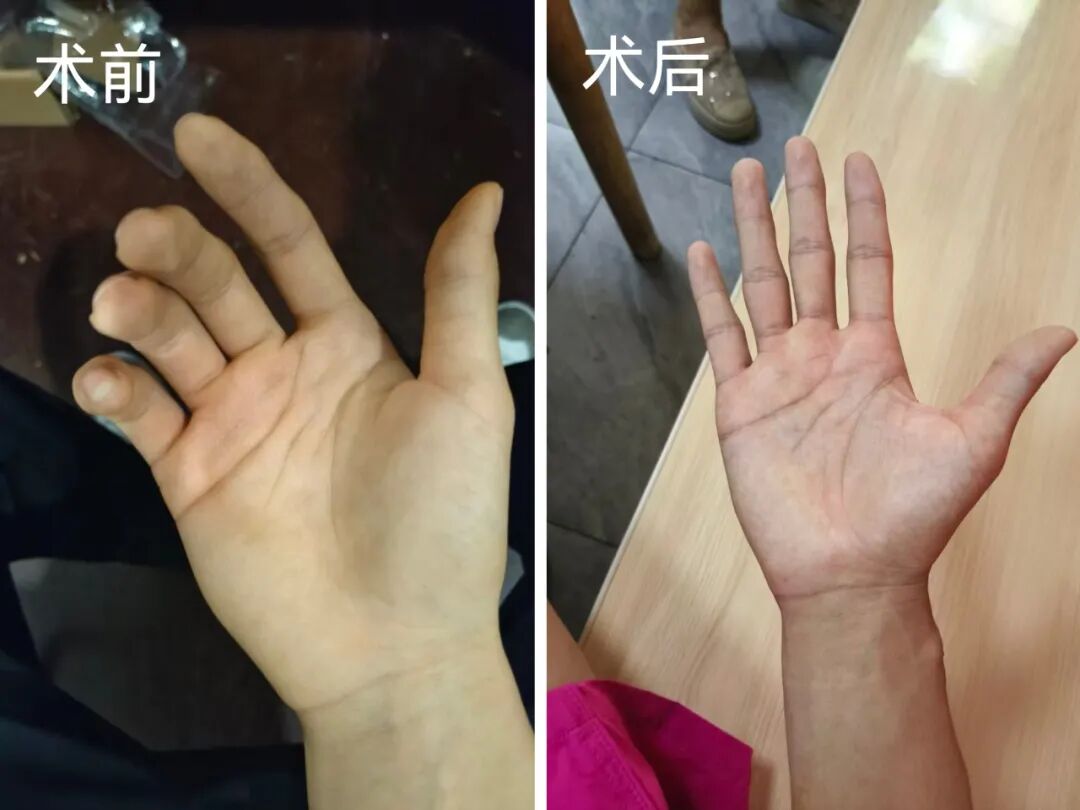 17 岁杂技少年终于找回了属于他的「手指自由」