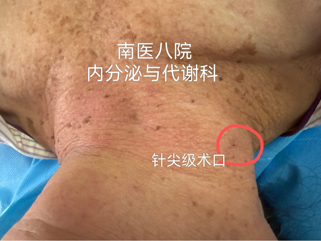 「针」实力!我院内分泌与代谢科甲状旁腺瘤热消融技术为患者解忧