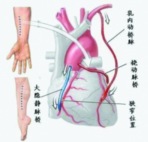 搭建「生命桥」:为老年危重冠心病患者重启「心」动力