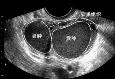 【超声病例】子宫卵巢巧克力囊肿,你了解吗?