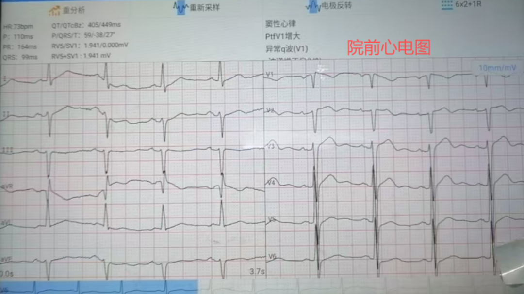 【守护健康】险！我院医护精准识破隐匿心梗，成功挽救患者生命