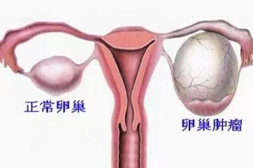 【超声病例】子宫卵巢巧克力囊肿,你了解吗?