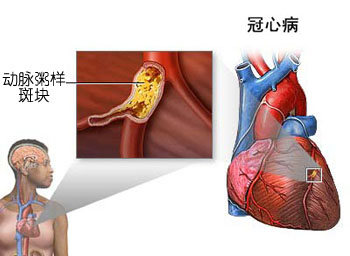 搭建「生命桥」:为老年危重冠心病患者重启「心」动力