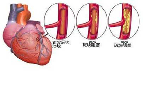 搭建「生命桥」:为老年危重冠心病患者重启「心」动力