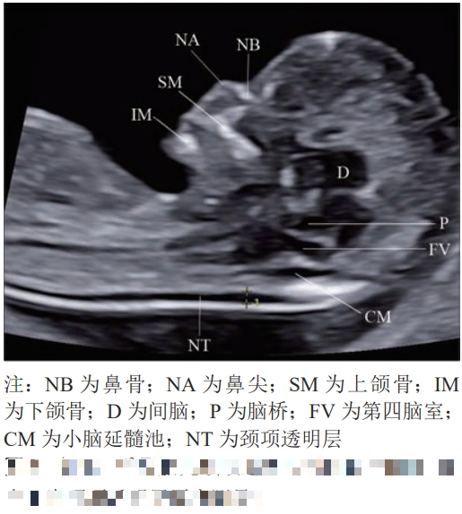 医语辟谣|NT 增厚,宝宝就一定有问题?别被吓住!