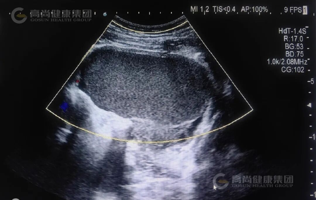 【超声病例】子宫卵巢巧克力囊肿,你了解吗?