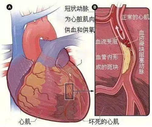 搭建「生命桥」:为老年危重冠心病患者重启「心」动力