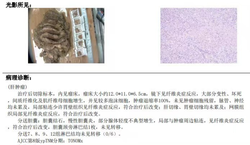 突破治疗局限 长春国文医院助力晚期肝癌患者实现临床康复