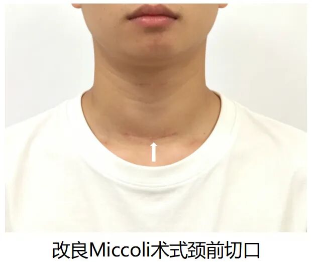 【协作组解病忧】二附院改良 Miccoli 术式为 19 岁甲状腺癌少年留住「天鹅颈」