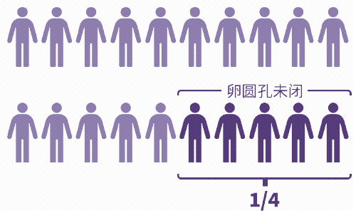 「剪秋,本宫头好痛!」—— 偏头痛不是矫情,是 10 亿人的脑内「风暴」