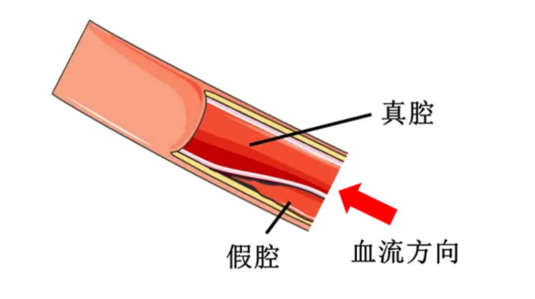 颈部「墙壁」撕裂，大脑瞬间缺血！这个隐藏的脑梗病因，年轻人尤其要警惕！