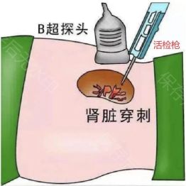 中山医声 | 别怕肾穿刺！肾病精准诊疗的 「透视眼」，微创又安心