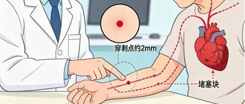 为什么在手腕上打一个针眼，就打通心脏堵塞的血管？干货科普来了