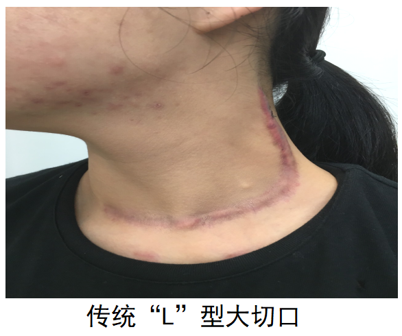 【协作组解病忧】二附院改良 Miccoli 术式为 19 岁甲状腺癌少年留住「天鹅颈」