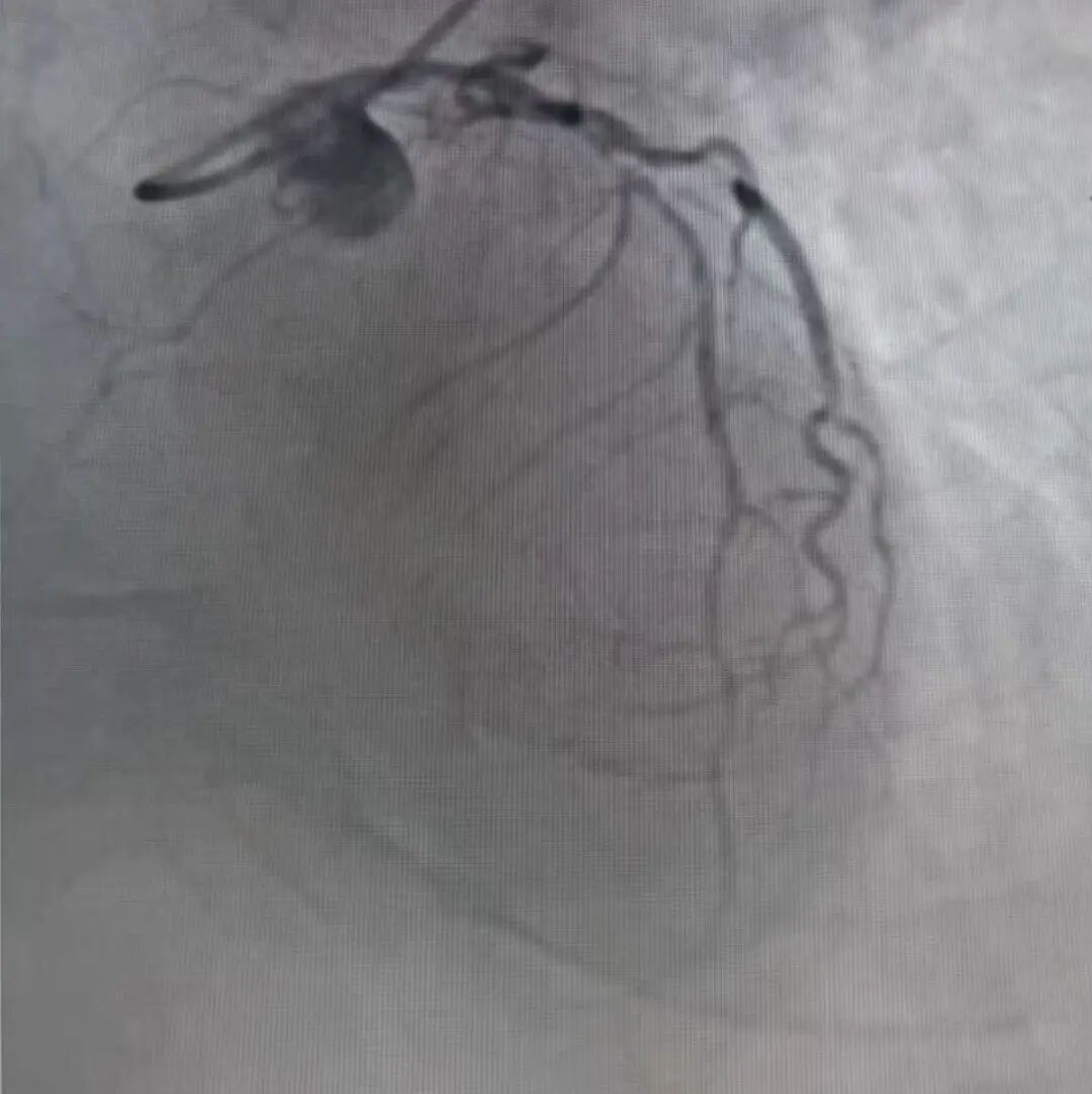 跨越双重病痛!小儿麻痹心梗患者成功植入支架,国文心内科守护生命尊严