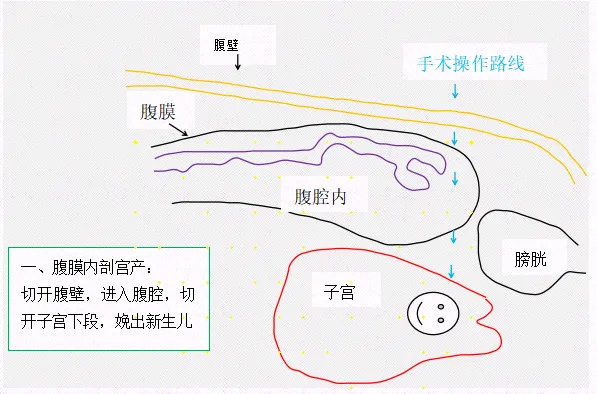 三胎妈妈带着「6 重高危 buff」闯关：腹膜外剖宫产+加速康复外科，生娃就像睡了一觉