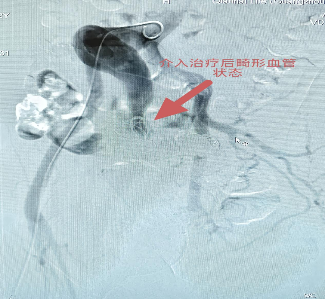 62 岁阿叔盆腔里藏着根「血管炸弹」！介入栓塞术成功「拆除」罕见髂内巨大动静脉畸形
