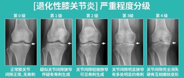 膝盖痛别硬扛！76 岁老人重度膝内翻畸形，骨科专家为其「换膝」解除病痛