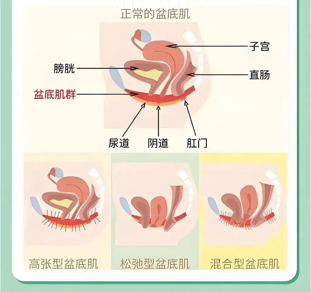 「笑尿了」？这可不是一句玩笑话！是你的盆底肌正在「求救」！