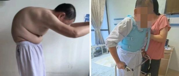 18 年无法抬头！100° 重度驼背的「折叠人」，在这里重新挺直脊梁
