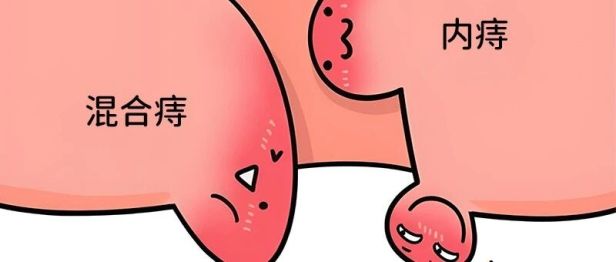 摆脱痔疮非常管用的方法，竟然是……