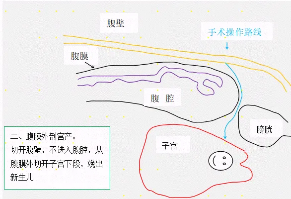 三胎妈妈带着「6 重高危 buff」闯关：腹膜外剖宫产+加速康复外科，生娃就像睡了一觉
