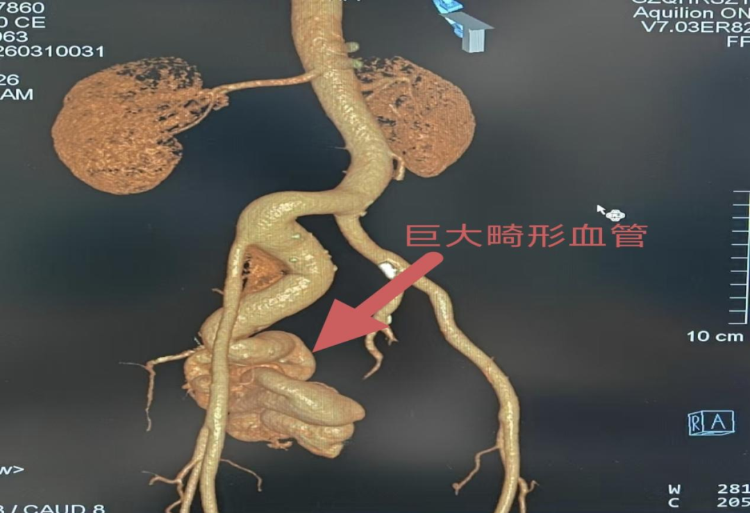 62 岁阿叔盆腔里藏着根「血管炸弹」!介入栓塞术成功「拆除」罕见髂内巨大动静脉畸形