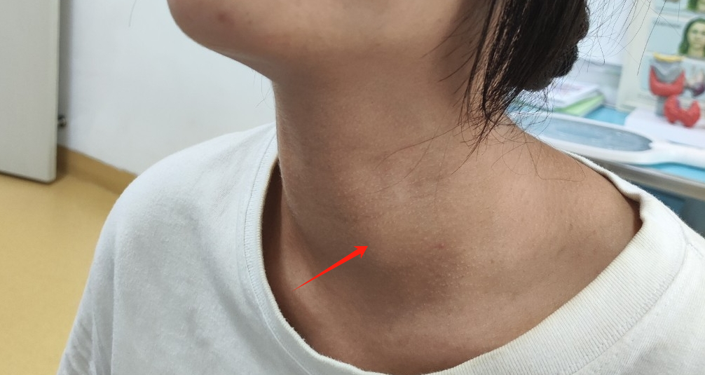 【守护健康】信了「懒癌」说法,她把甲状腺癌从低危拖成了中危……