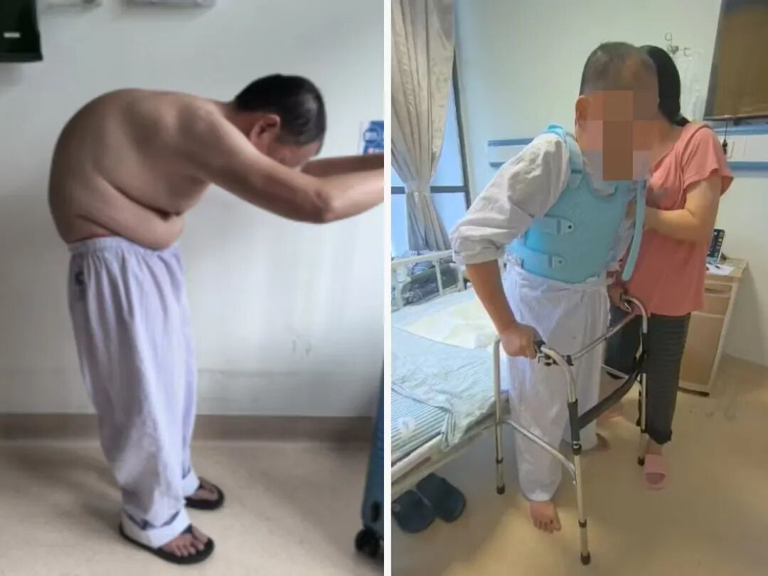 18 年无法抬头！100° 重度驼背的「折叠人」，在这里重新挺直脊梁