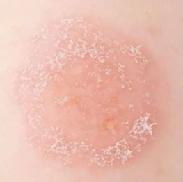 医路科普 | 脸上长了「桃花癣」？被误解的「白色糠疹」