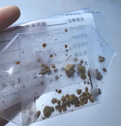胆囊被结石填满、胰腺炎反复发作——国文医院为 90 岁患者成功实施胆道探查取石术