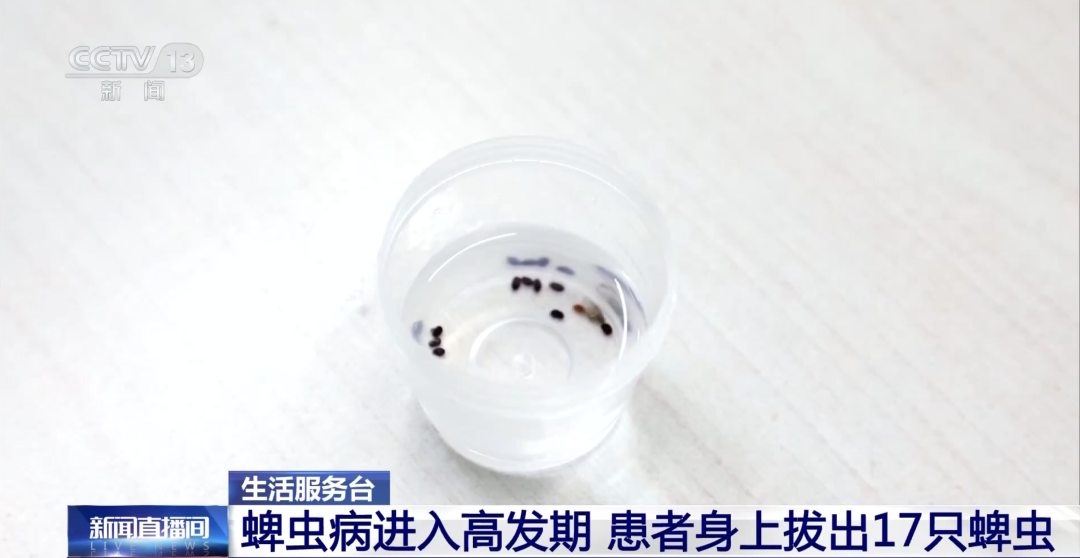 高烧不退,医生在他身上发现 17 颗「小黑点」!医生提醒:被咬后千万别硬拔