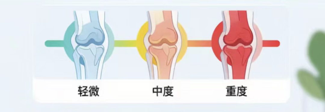 【专家讲堂】膝盖肿了、发胀?膝关节积液这样处理