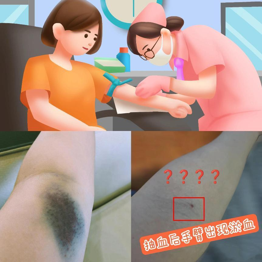 医语辟谣｜抽血后手臂淤青？是医生技术不过关？