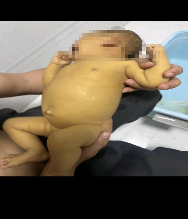体重不足 9 斤、肝衰竭危在旦夕:妈妈小小肝脏成了她的希望丨六一最好的礼物