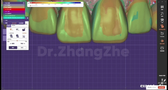 口腔美学新突破！青海首例数字化多颗瓷贴面修复顺利完成