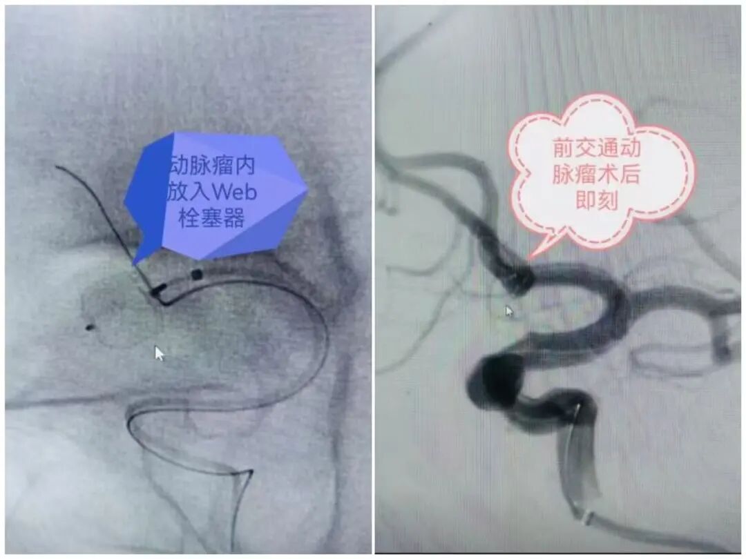 妙手仁心拆颅内「炸弹」,医患同心筑生命防线