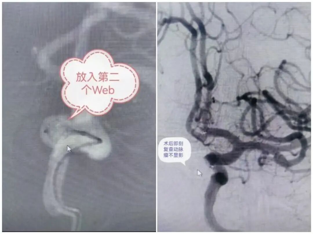 妙手仁心拆颅内「炸弹」,医患同心筑生命防线