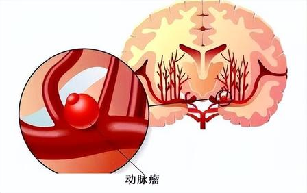 妙手仁心拆颅内「炸弹」，医患同心筑生命防线