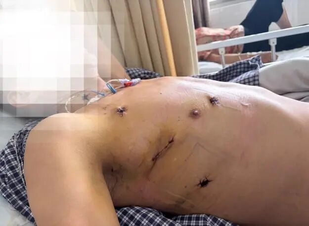【微创「心」突破】精准视野 免于换瓣——淮安市一院再次成功开展达芬奇机器人二尖瓣修复术